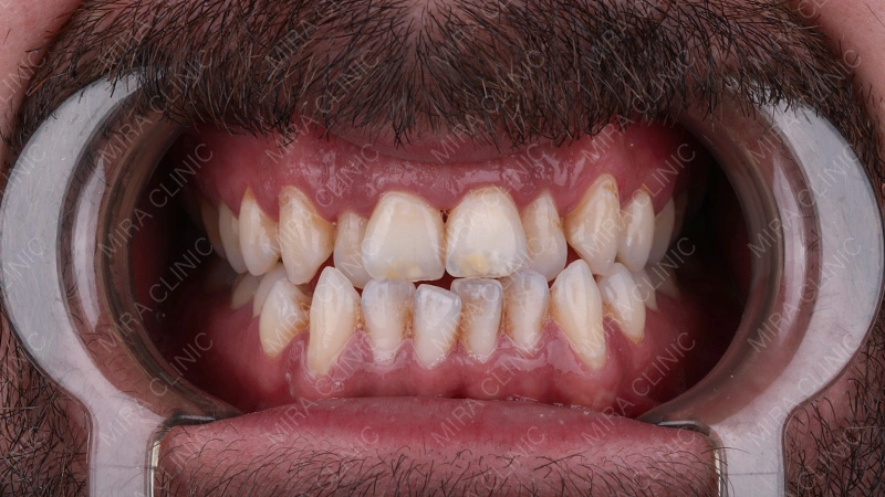 severe crowding teeth